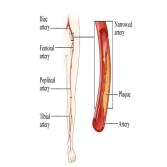 دعامة الأوعية الدموية
